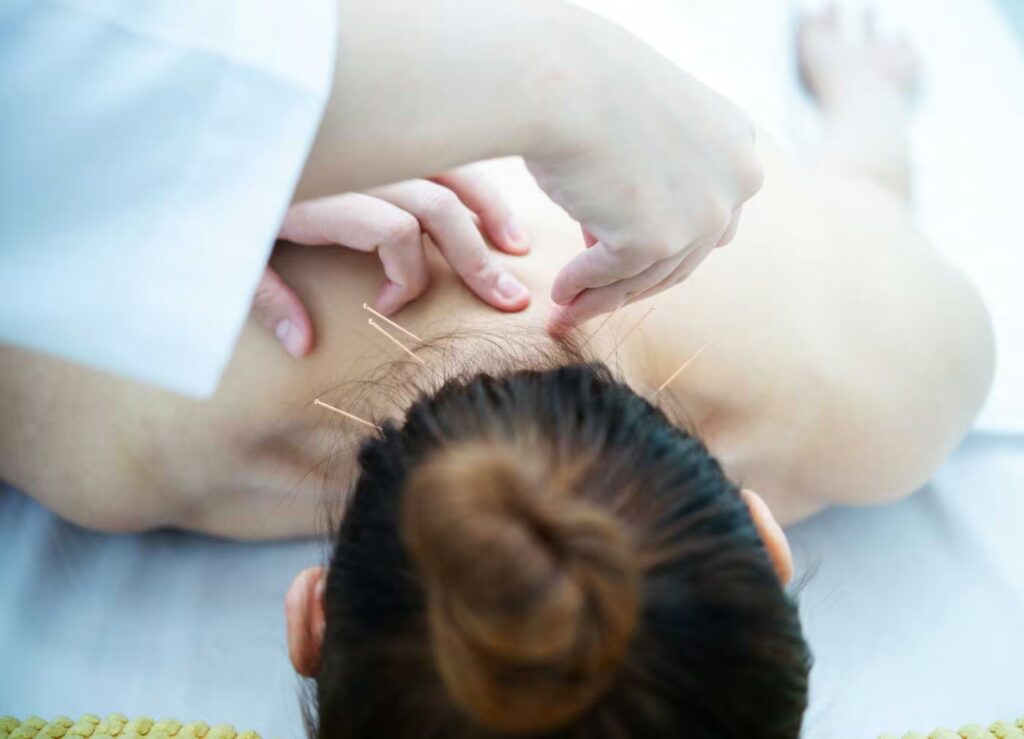 a practitioner inserts fine acupuncture needles in 2026 01 09 11 58 40 utc